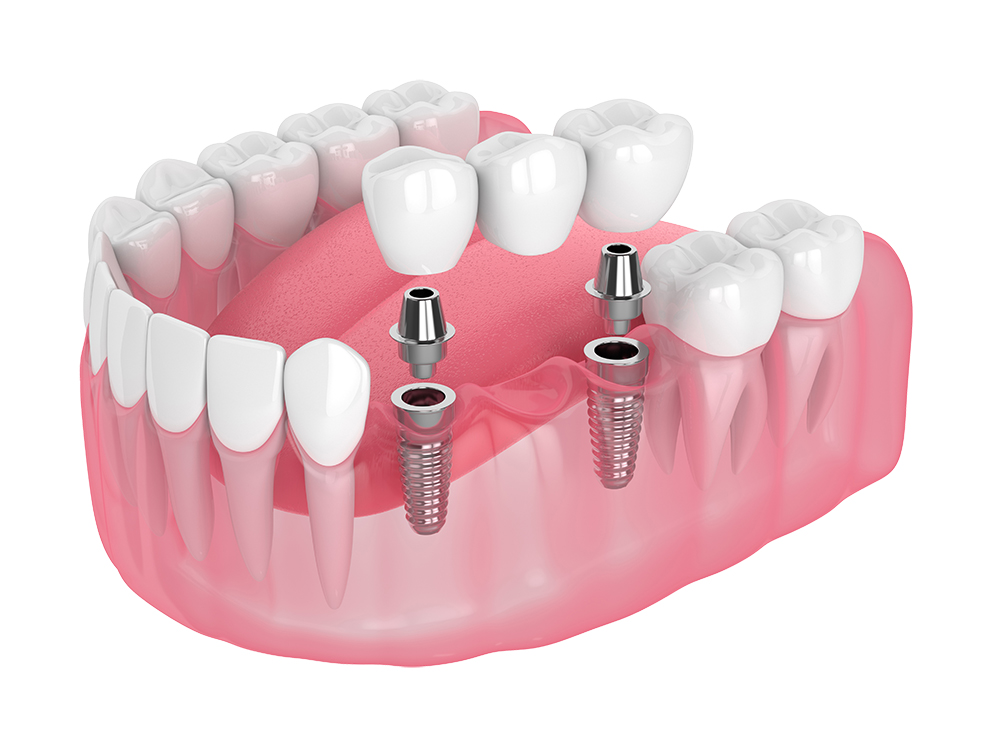 Implants Multiple Teeth